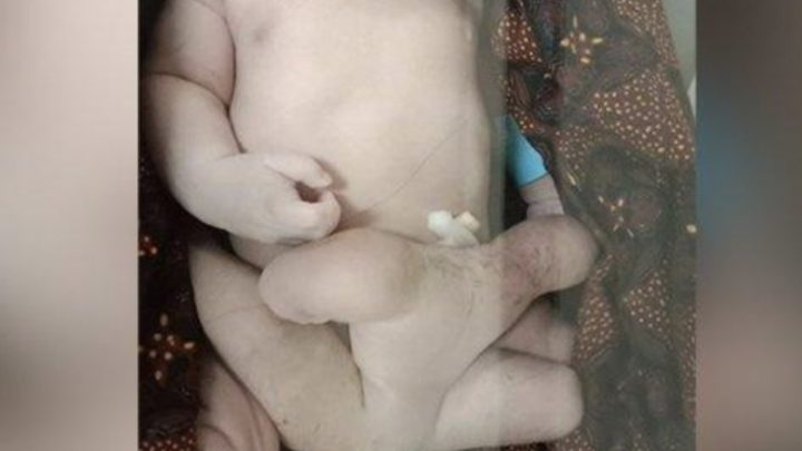 Heboh! se-Indonesia! Perempuan Ini Melahirkan Bayi Berkaki 6, Setelah Dicek Dokter, Astaga Ternyata….